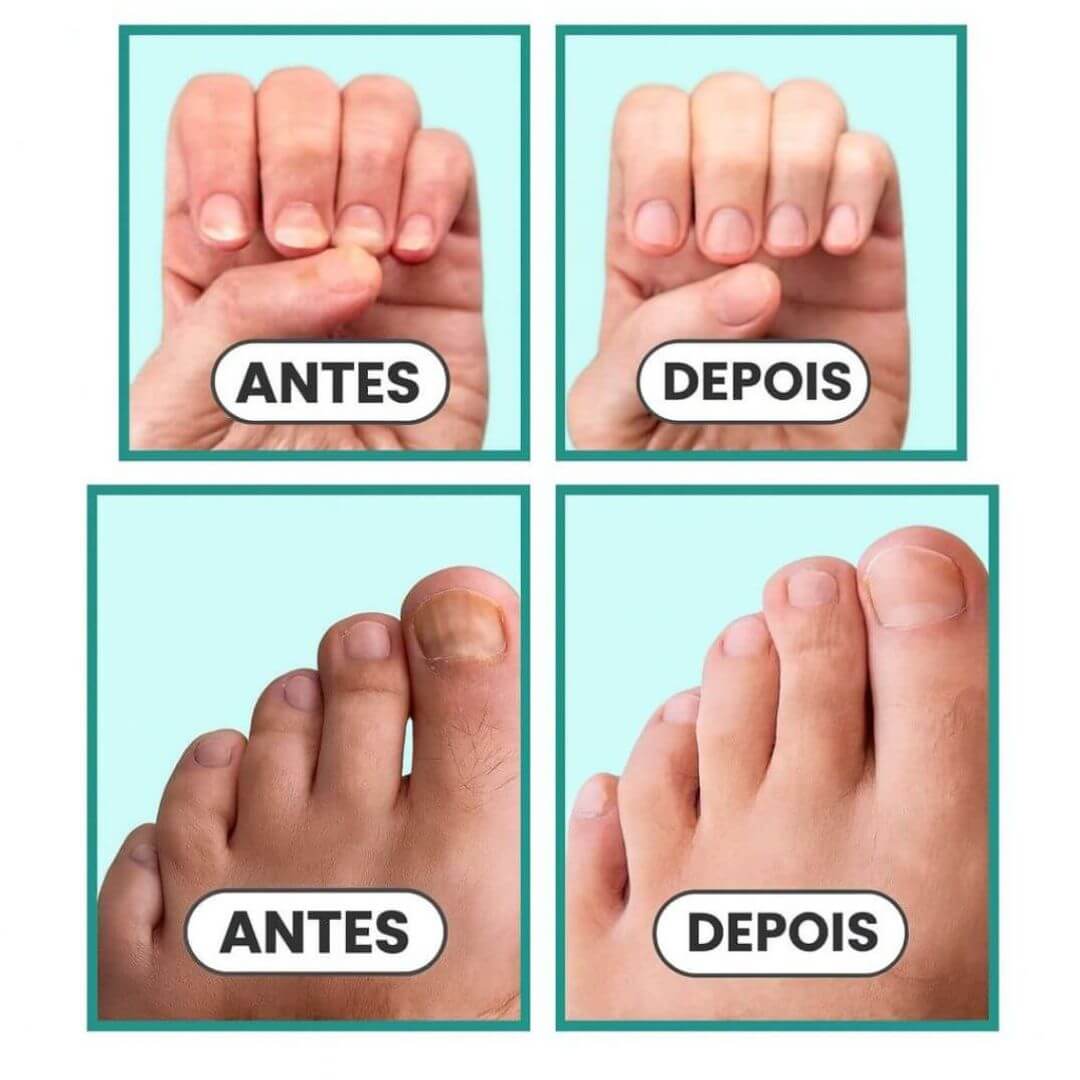 Tratamento para micose nas unhas | ClearNail Pro