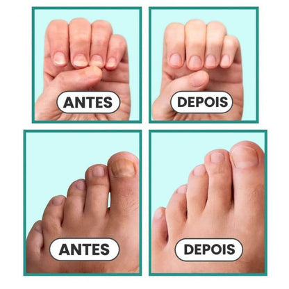 Tratamento para micose nas unhas | ClearNail Pro