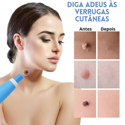 Kit anti-verrugas | Zero Verrugas