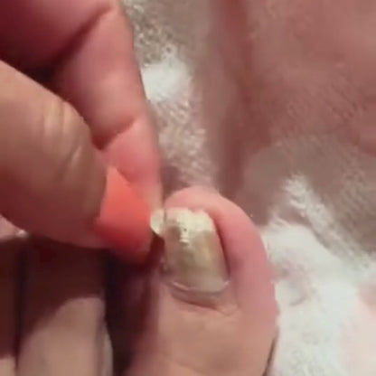 Tratamento para micose nas unhas | ClearNail Pro